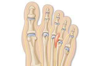 A diagram of a foot with swelling in the middle of the toe.