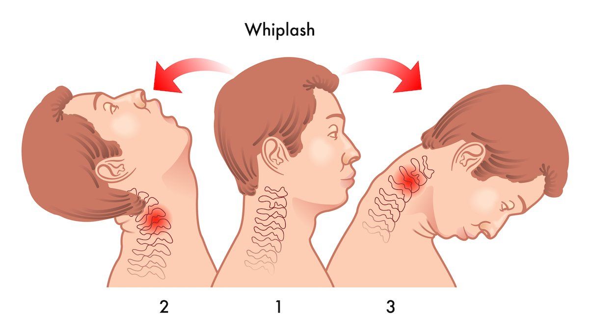 A cartoon of a man 's neck with whiplash.