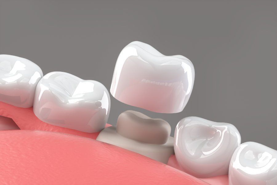 Tooth crown being fitted on prepared tooth in pink gums; close-up view.