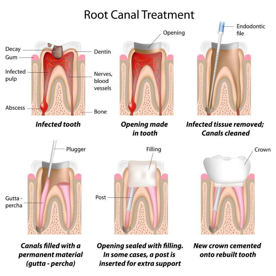 Diagram illustrating root canal treatment: removing infected pulp, cleaning canals, filling, and crown placement.