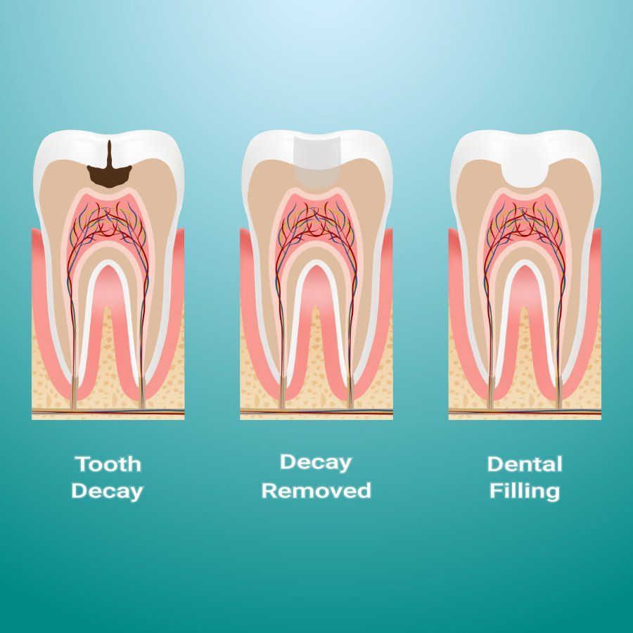 Tooth decay process illustrated. Stages: tooth decay, decay removed, dental filling.