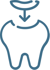 Tooth with a missing section; a crown is being placed on it.