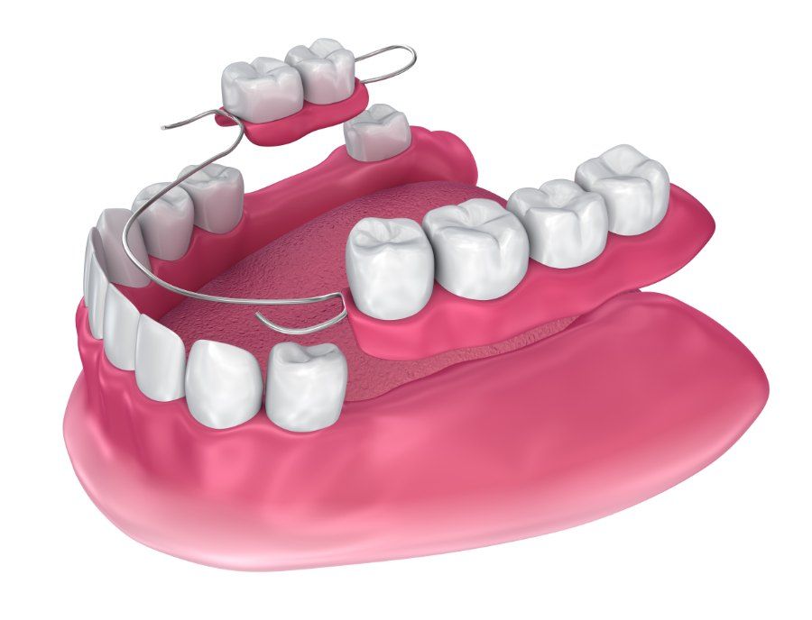 Illustration of a partial denture with artificial teeth and metal clasps, set on pink gums.