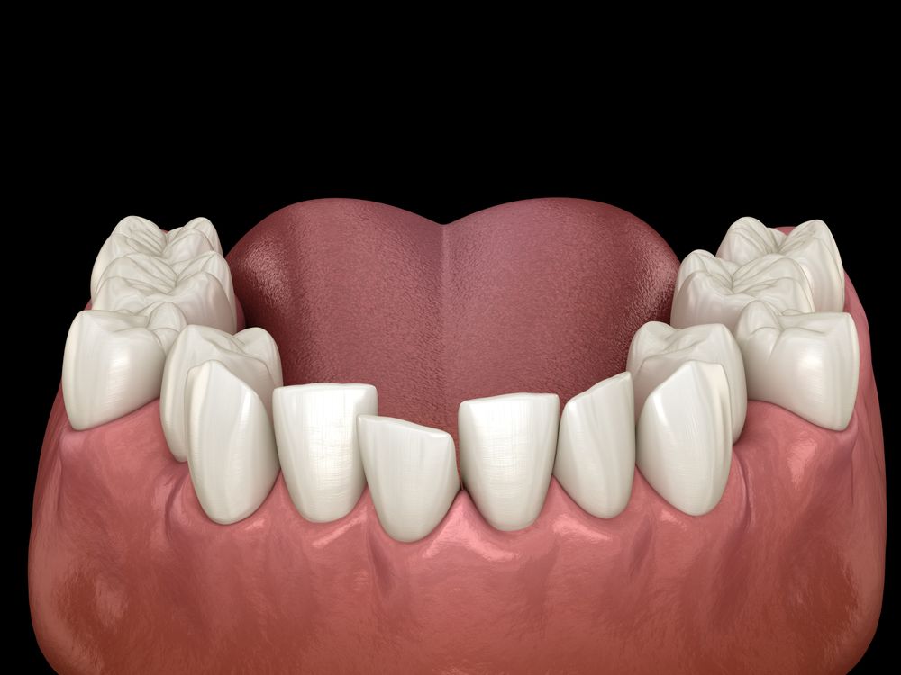 A 3D dental rendering showing a set of lower human teeth with mild crowding and misalignment in the front.