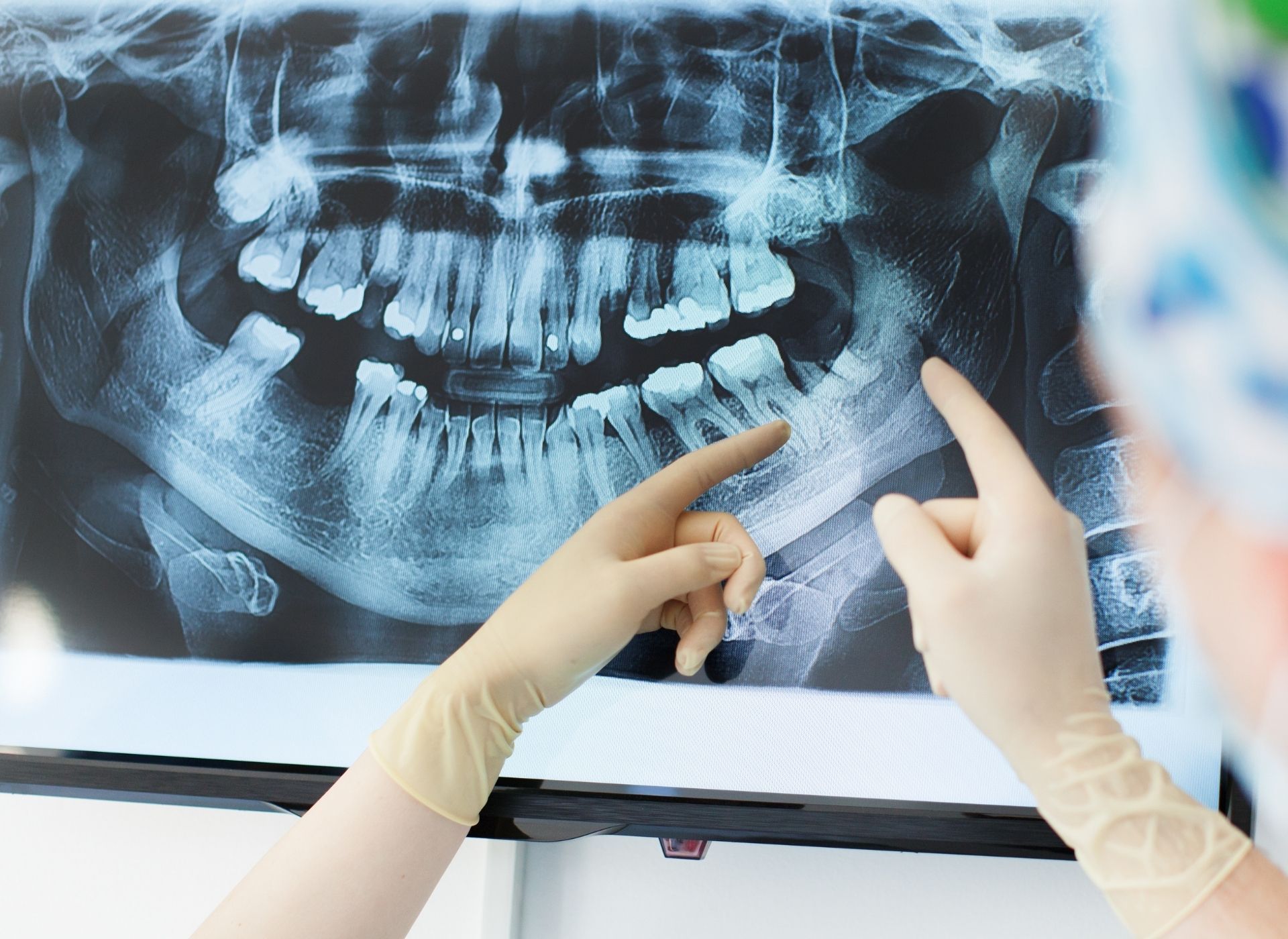 A gloved professional points to a specific area on a panoramic dental X-ray displayed on a screen.
