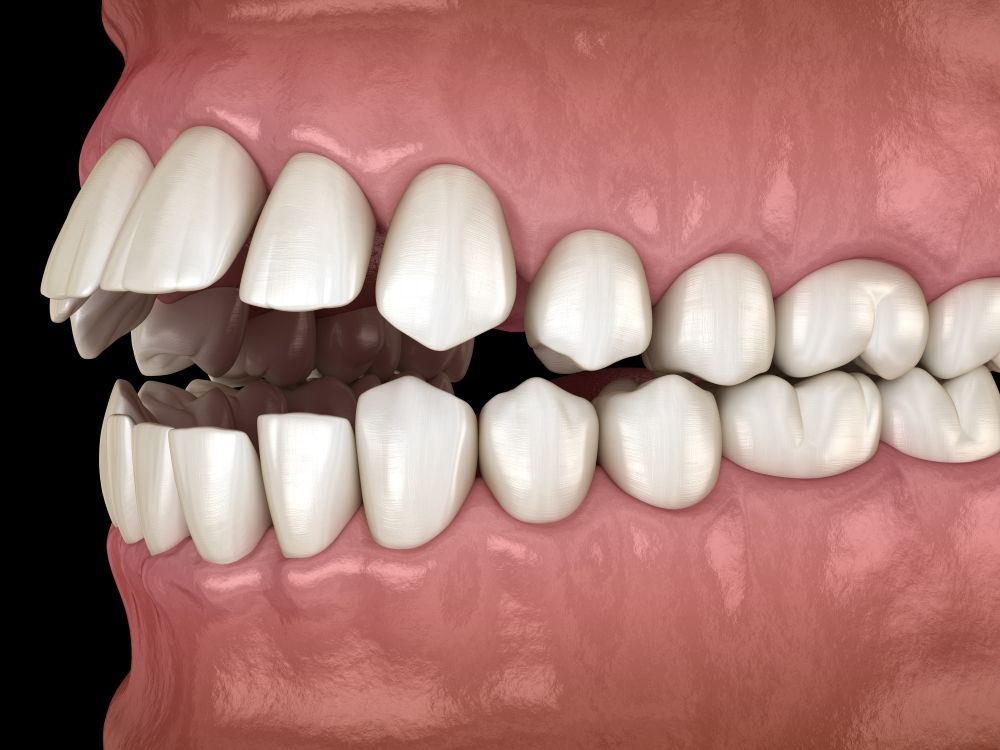 A side view of a dental model showing an open bite malocclusion where front teeth do not meet when the mouth is closed.
