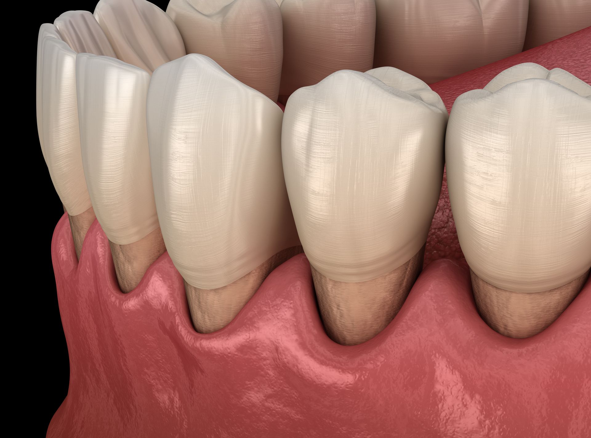 A 3D render of human teeth showing signs of gum recession, revealing the tooth roots above the gum line.
