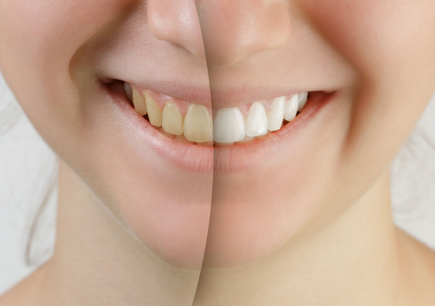 A split-screen comparison showing yellowed teeth on the left and whitened teeth on the right.