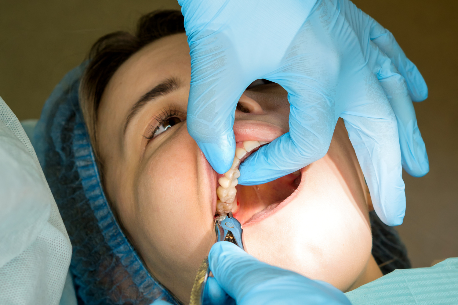 A dental professional in blue gloves examines a patient's teeth with a metal dental instrument.
