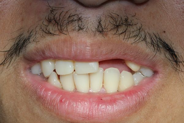 Two Dental Implants Before