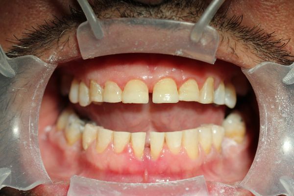 Upper Implants After