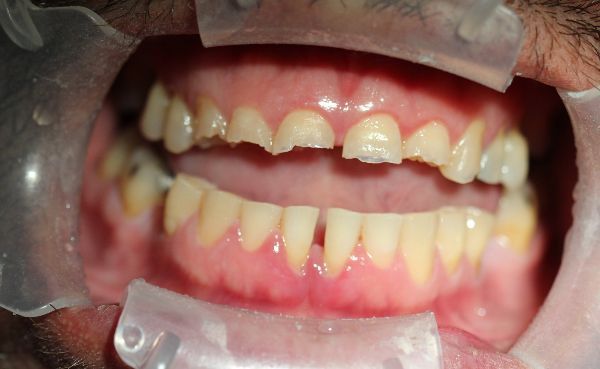 Upper Implants Before