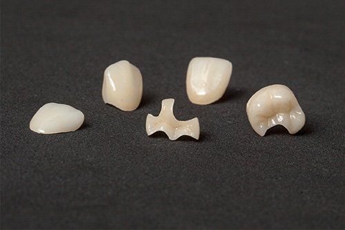 Inlays and Onlays at Galvez Dentistry