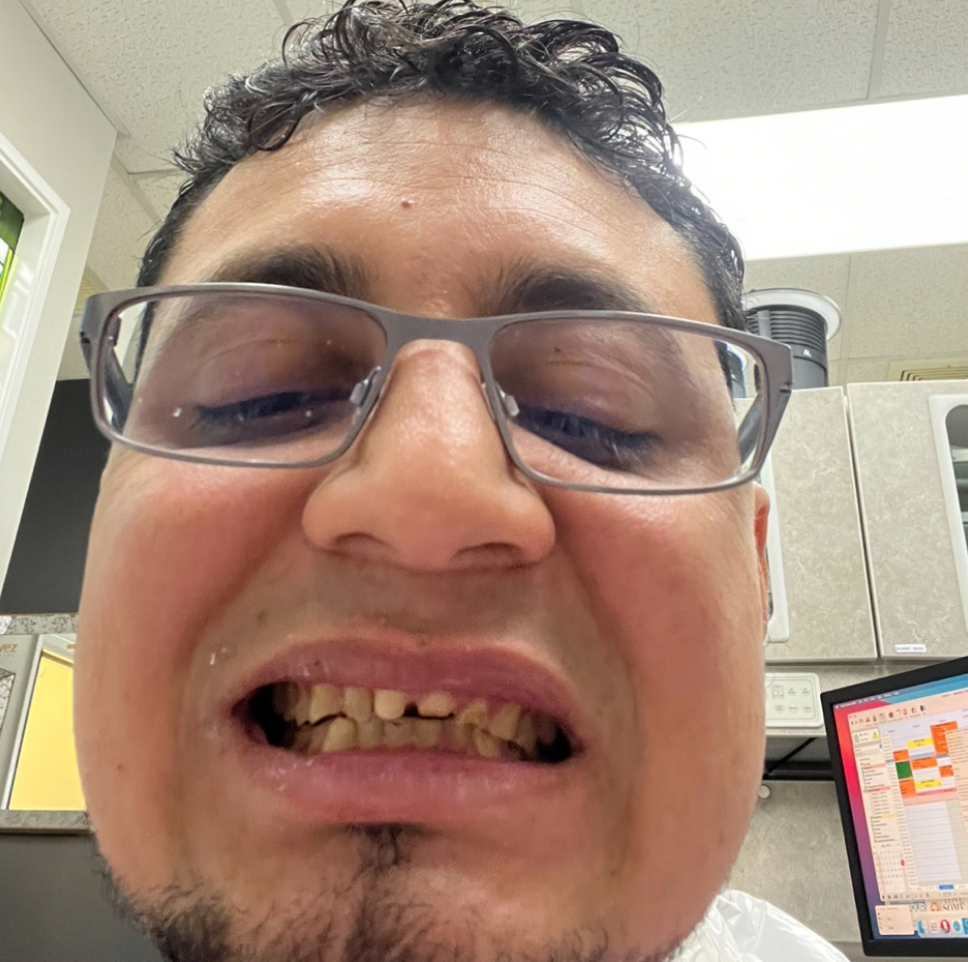 Dental Implants Before