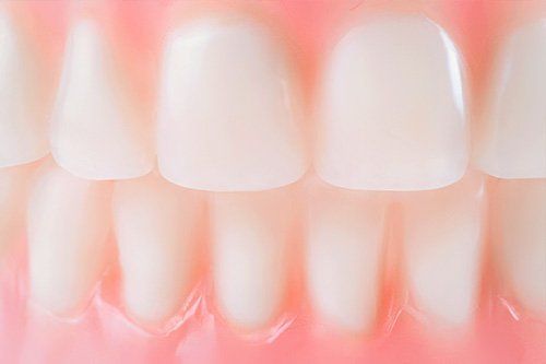Dental Bonding image from Galvez Dentistry