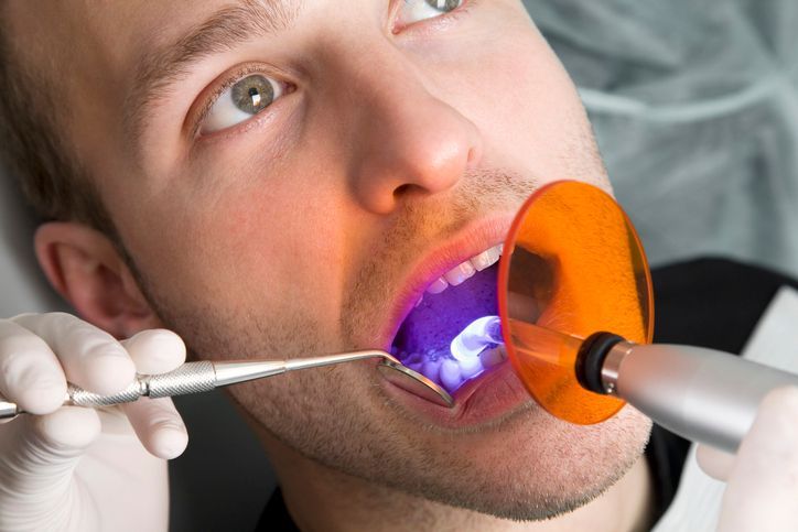 Dentist curing a tooth with blue UV light and orange shield during a dental procedure