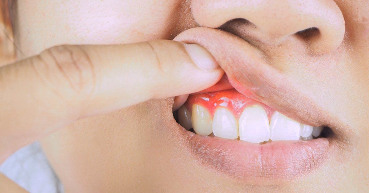 reversing gum disease