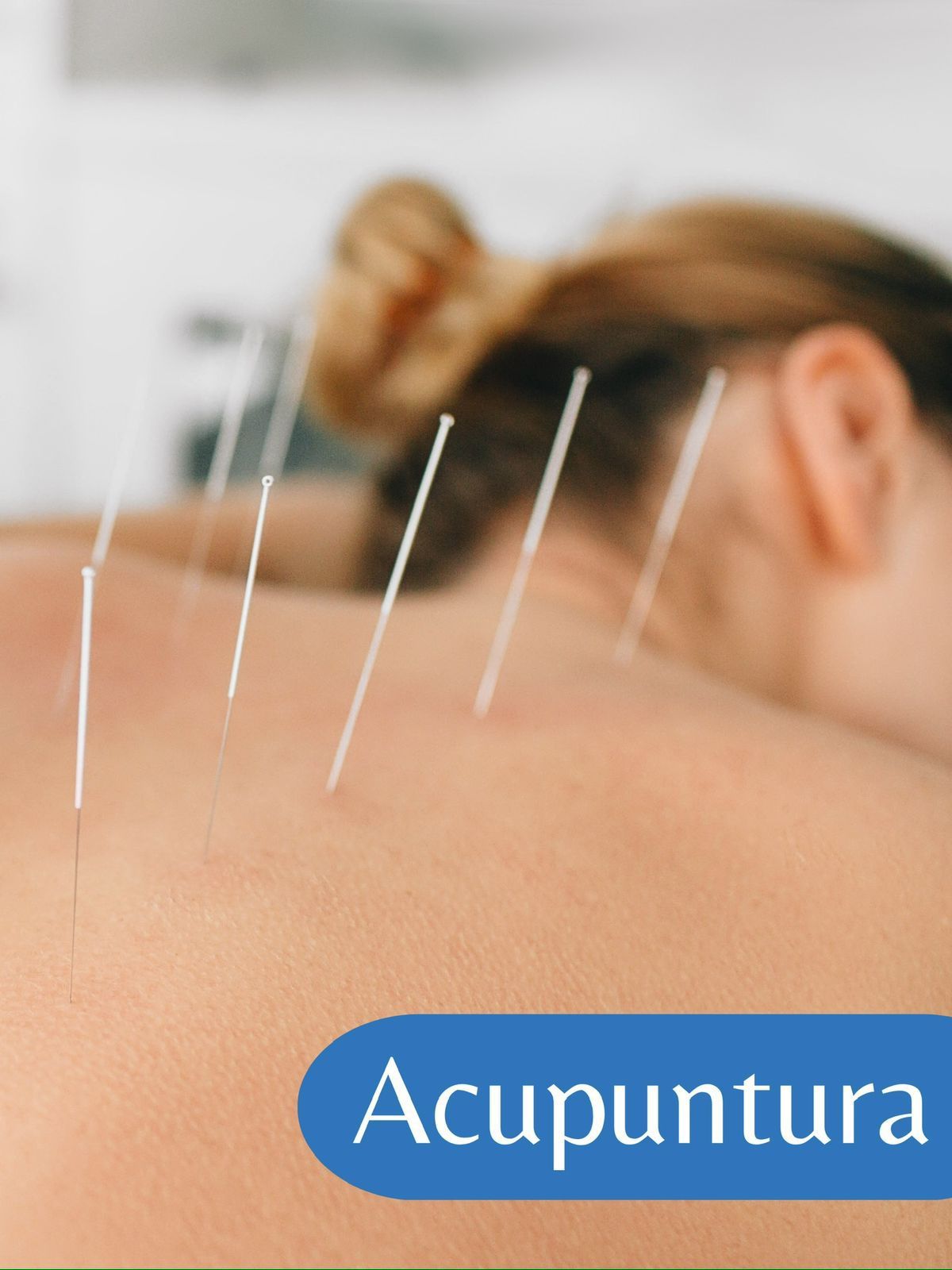 Persona recibiendo acupuntura en la espalda; agujas insertadas.