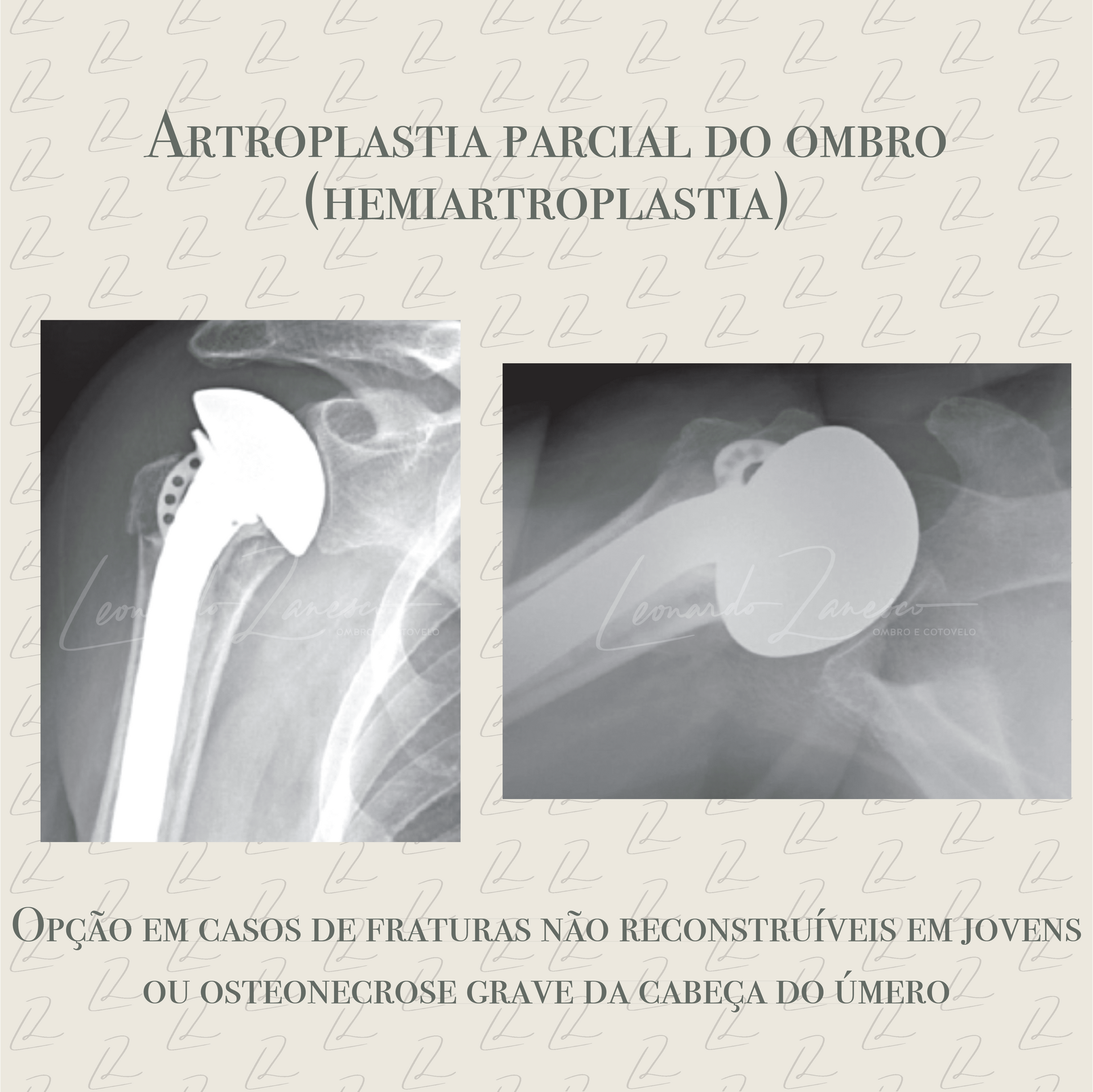 Artroplastia do ombro: Conheça as indicações e entenda sobre