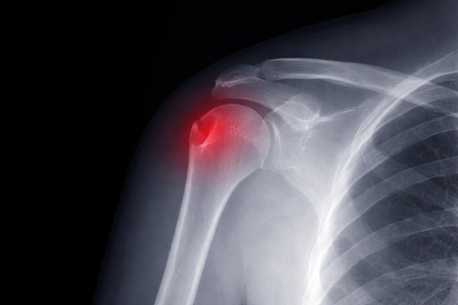 lesão de hill sachs precisa de cirurgia