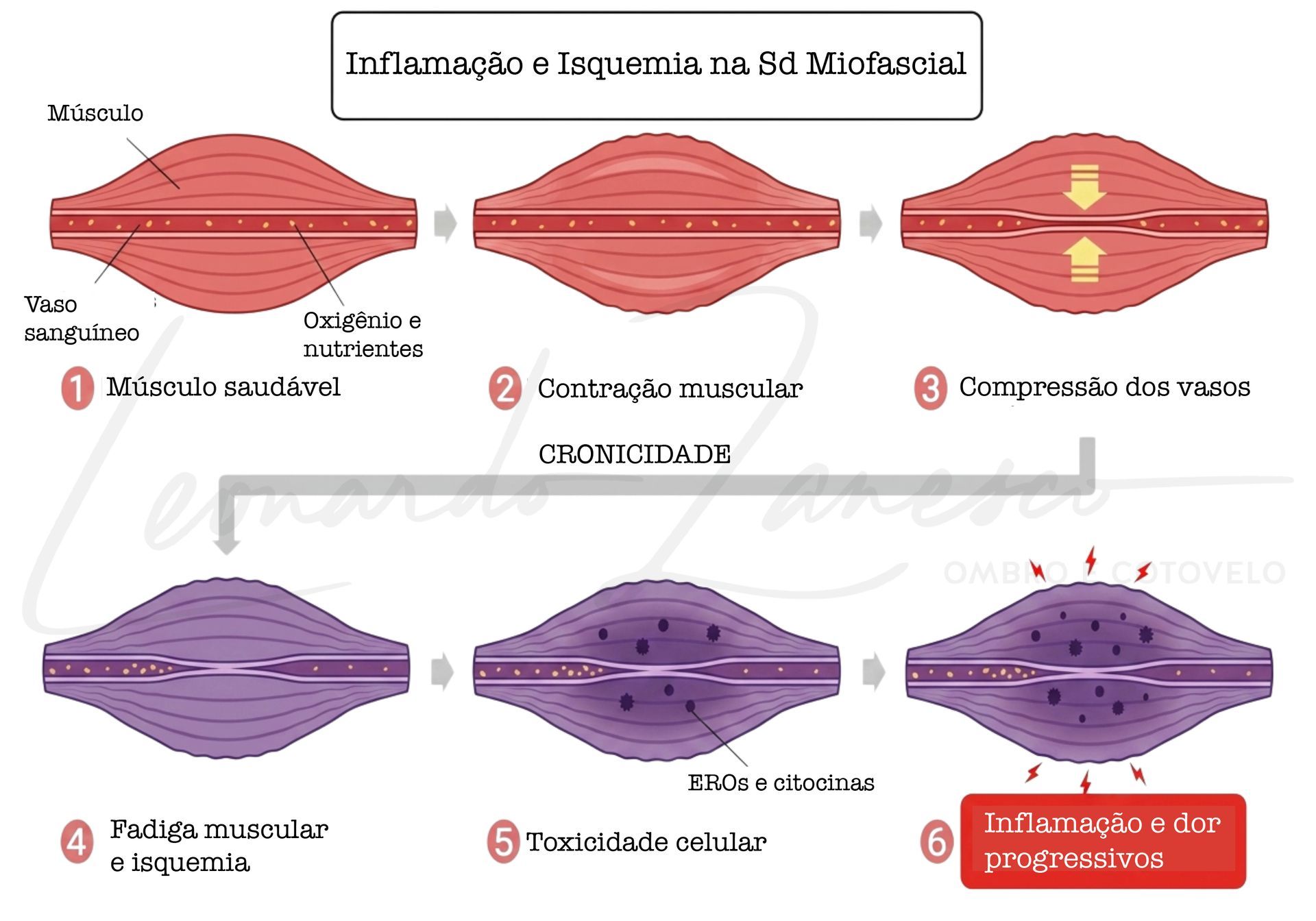 inflamacao e esquemia na sd miofascial