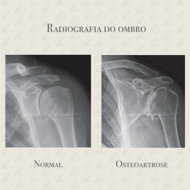Ombro Com Osteoartrite