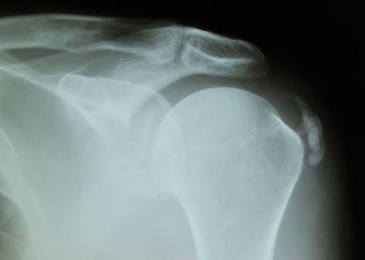 barbotagem/ tendinite calcificada