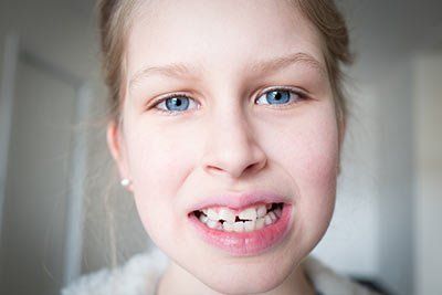 Cracked Tooth? What To Do When You Can't Get To A Dentist Right Away