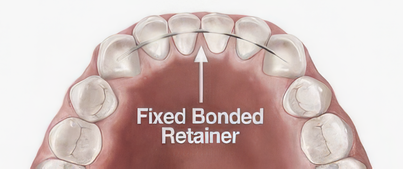Information on the Long Term use of Retainers