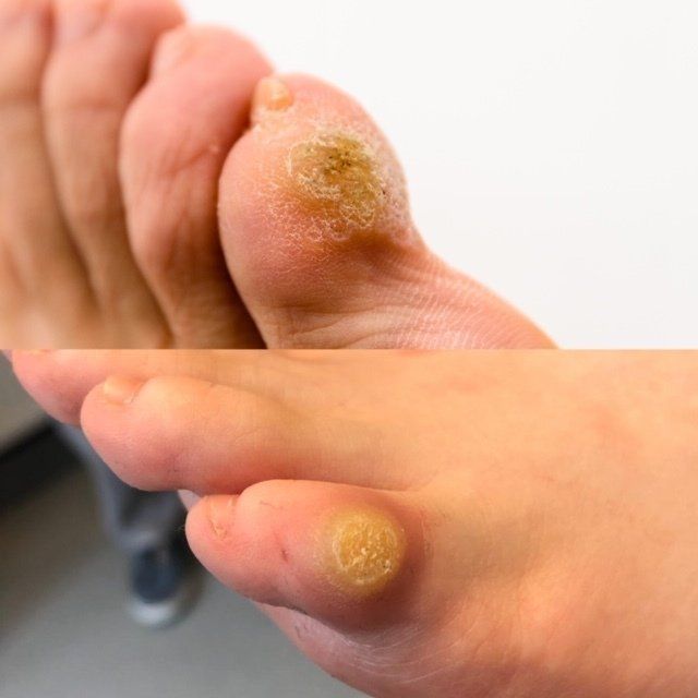 veruca foot disease