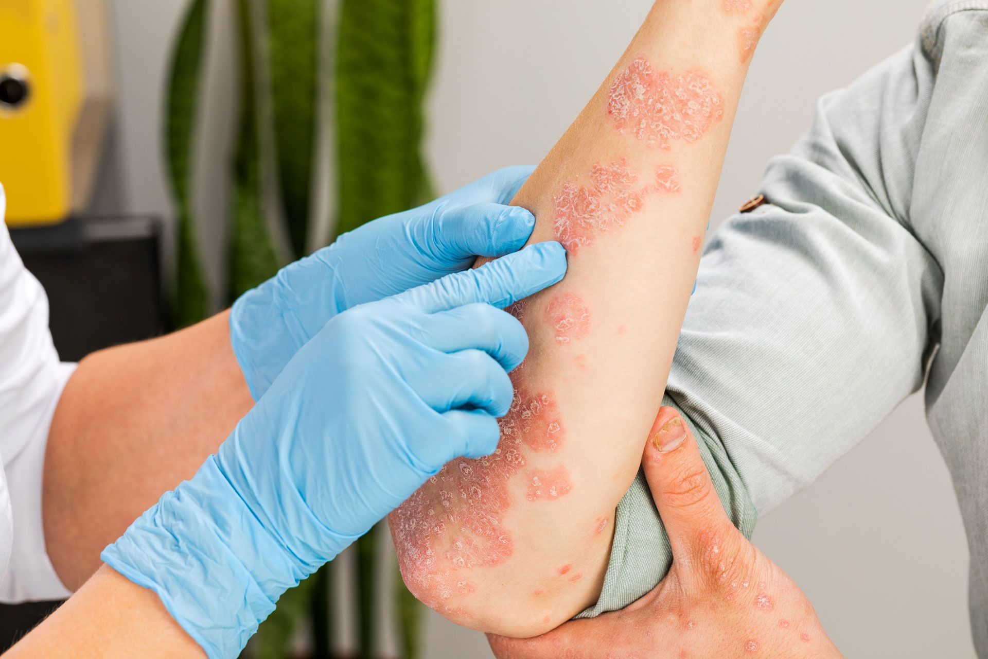 A doctor is examining a patient 's arm with psoriasis.