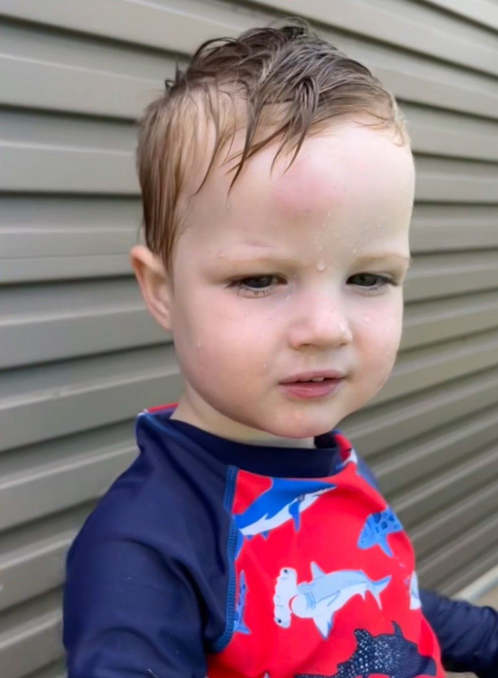 Close-up of a young boy with a swollen red lump on his forehead after a head bump.