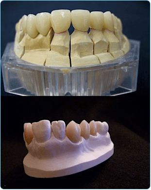Two different moulds of a bottom set of teeth