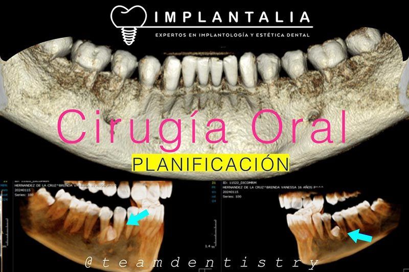IMPLANTALIA