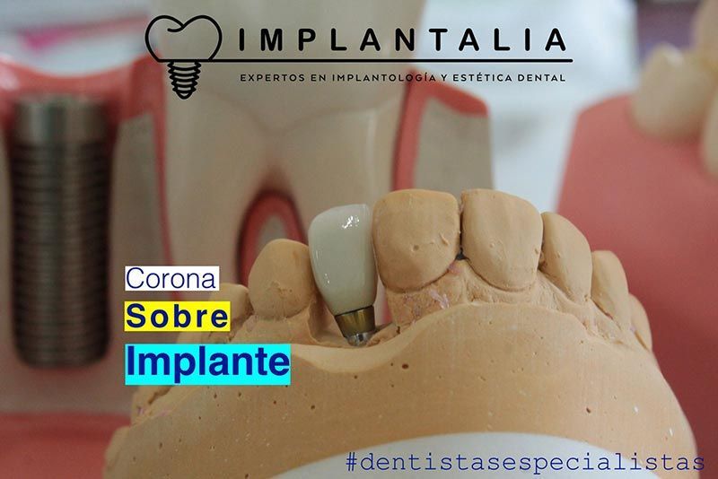 IMPLANTALIA