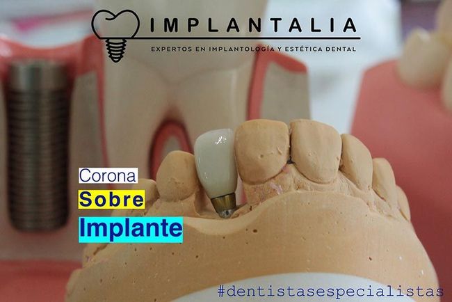 IMPLANTALIA