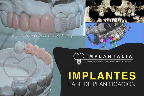 IMPLANTALIA