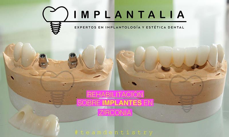 IMPLANTALIA