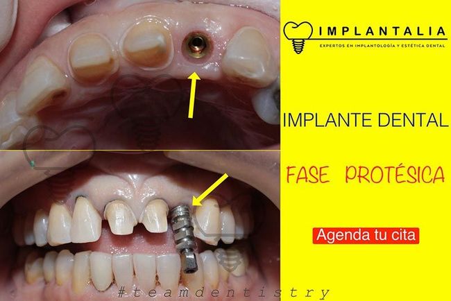 IMPLANTALIA