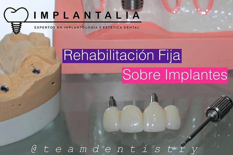 IMPLANTALIA