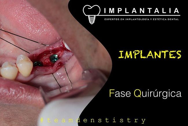 IMPLANTALIA