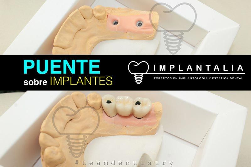 IMPLANTALIA