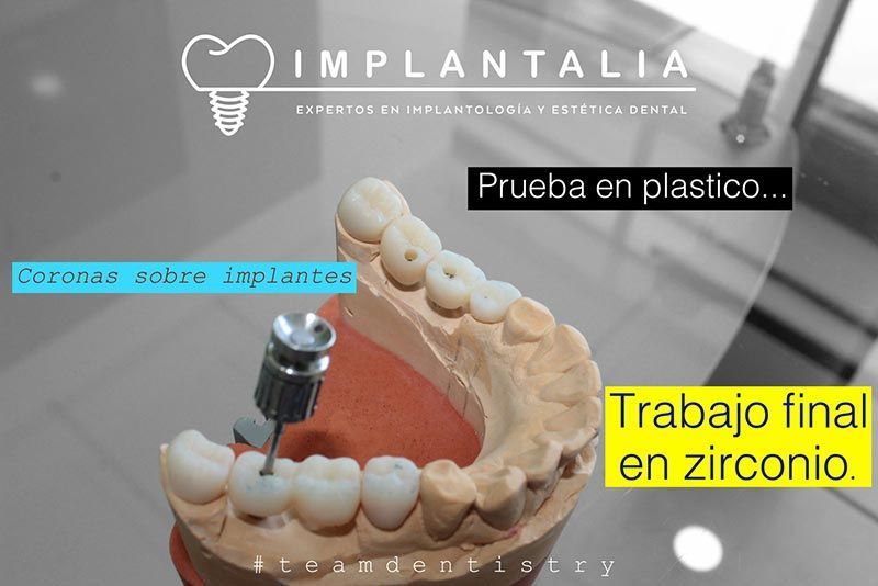 IMPLANTALIA