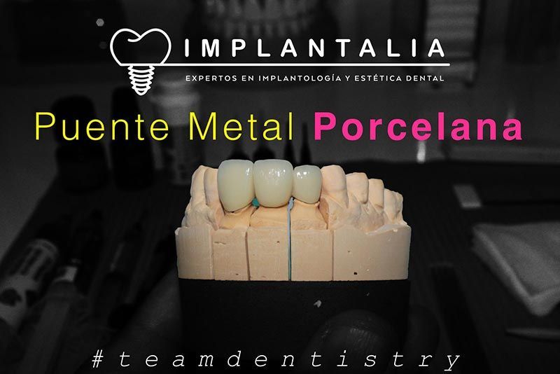 IMPLANTALIA