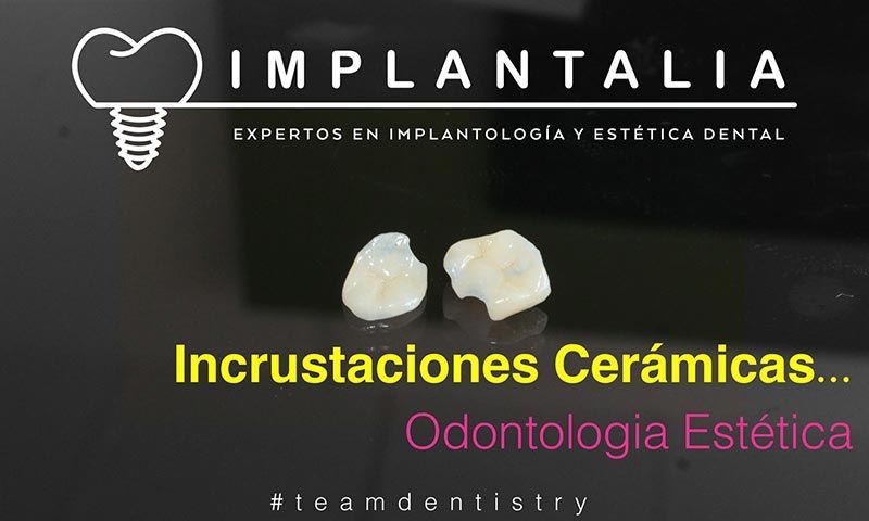 IMPLANTALIA