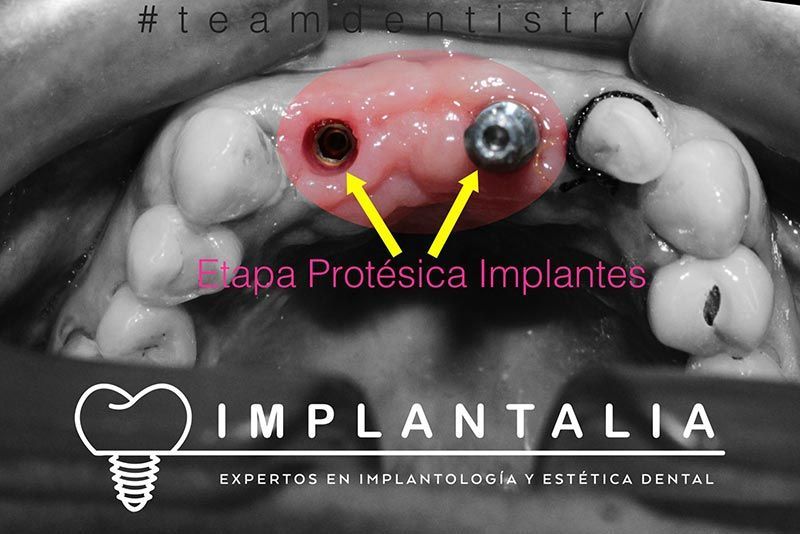 IMPLANTALIA