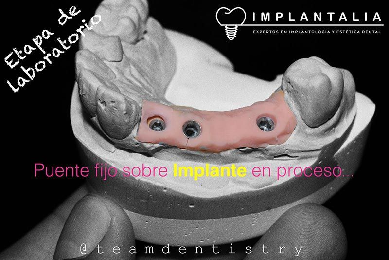 IMPLANTALIA