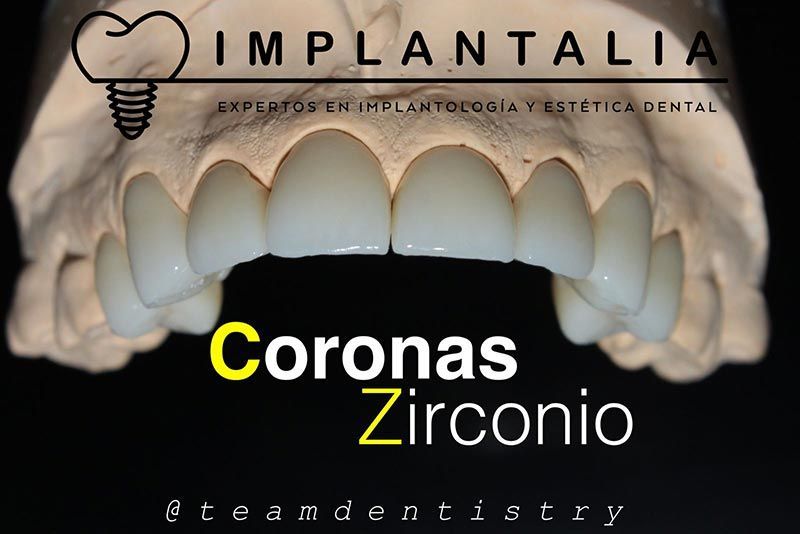 IMPLANTALIA
