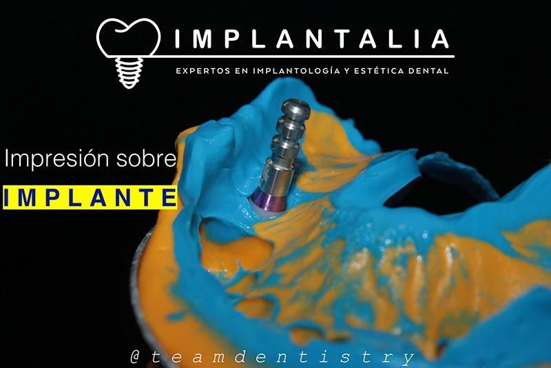 IMPLANTALIA