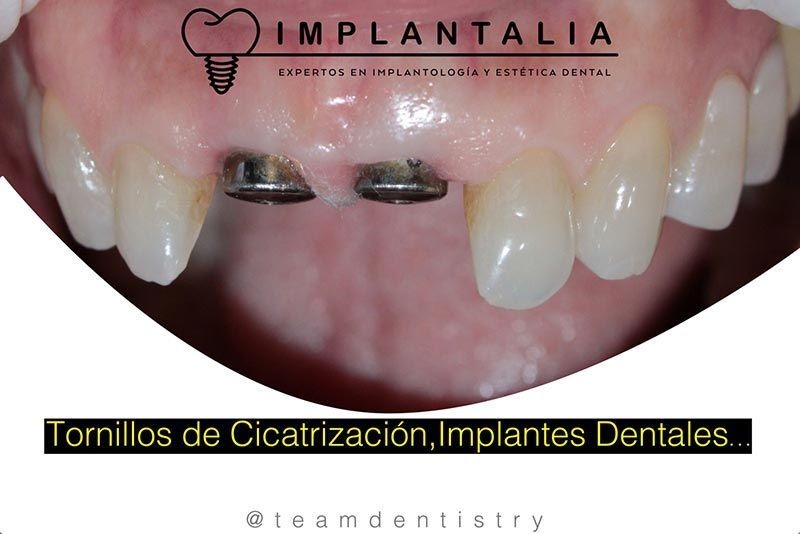 IMPLANTALIA